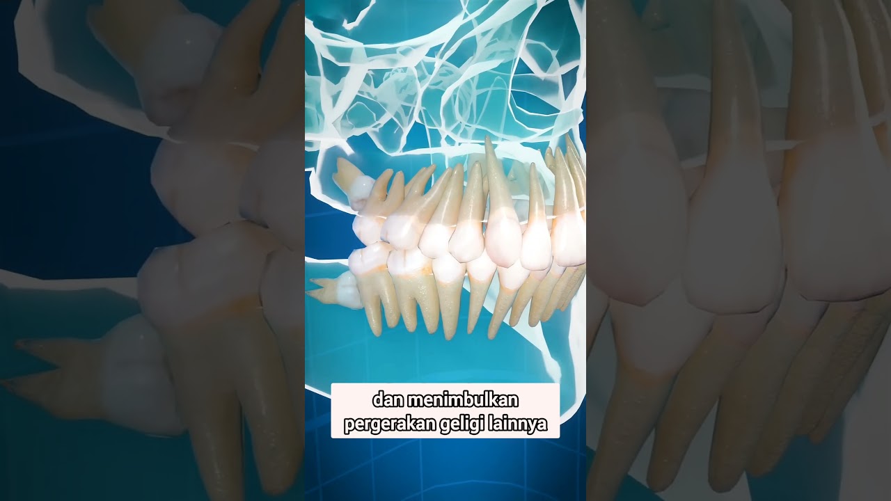 Mengapa Gigi bungsu impaksi dicabut? Apa yang terjadi