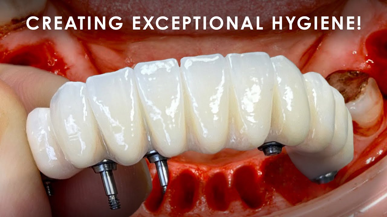 Creating Exceptional Hygiene for Full Mouth Implants