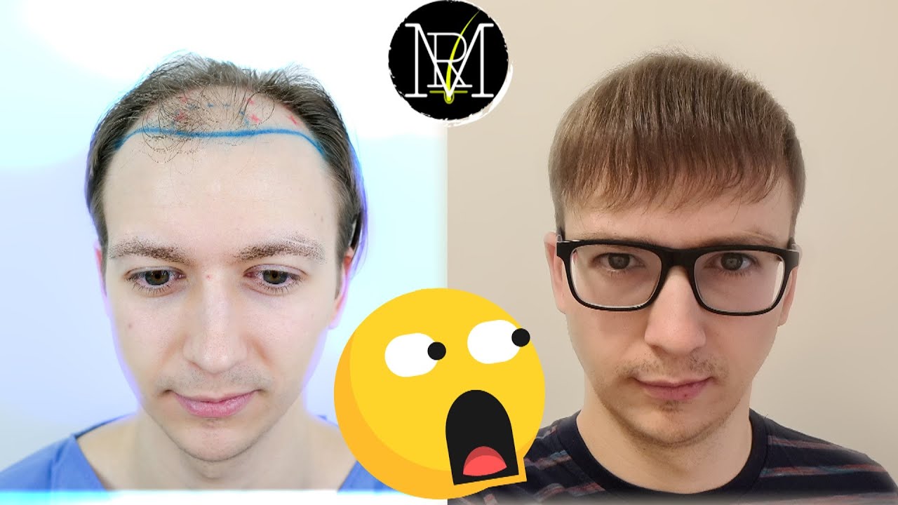Why your hair transplant hasn't matured yet | 9.5 month update