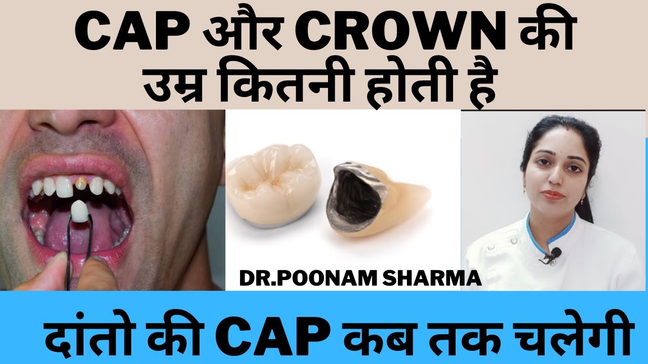 दांतो के कैप और क्राउन कितने समय तक चलते है | Cap or Crown ki Umar Kitni Hoti Hai