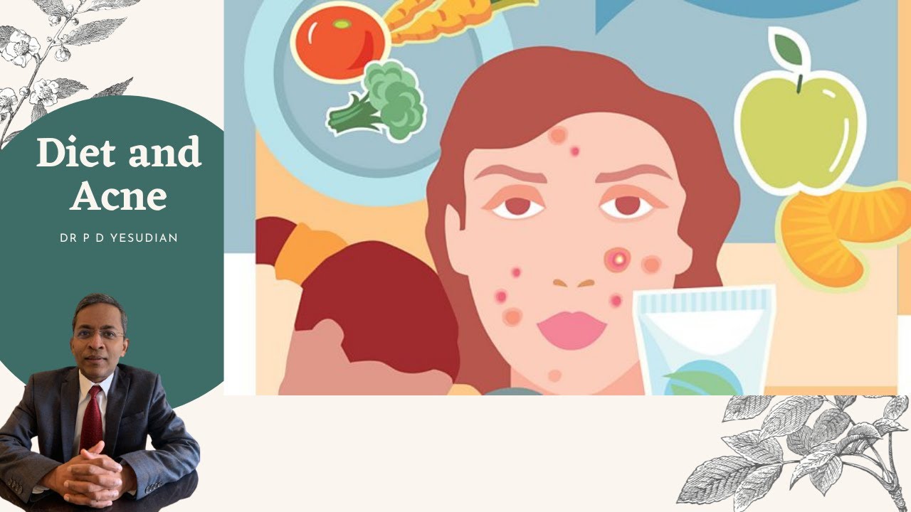 Diet and acne