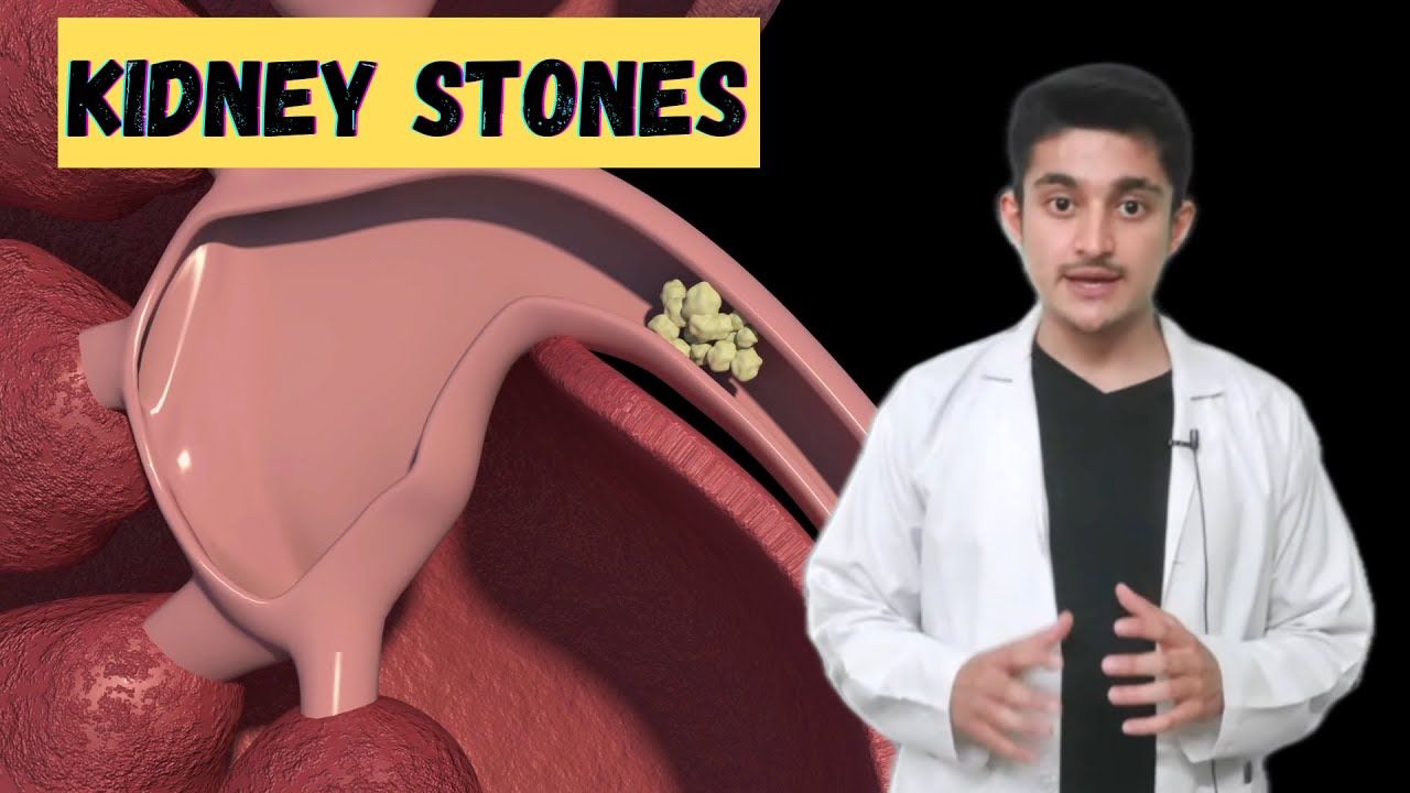 Kidney stones Renal calculi 3d animation | symptoms pain types treatment | how are they formed
