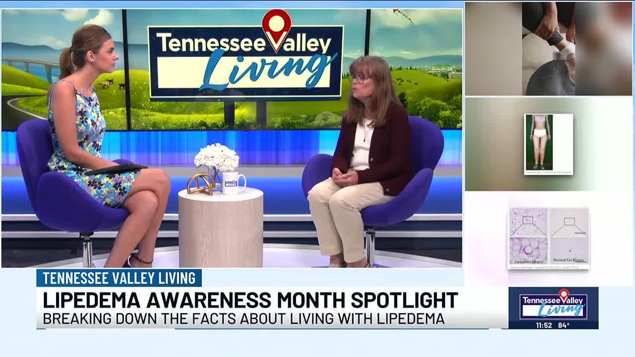 Breaking down the facts about living with Lipedema