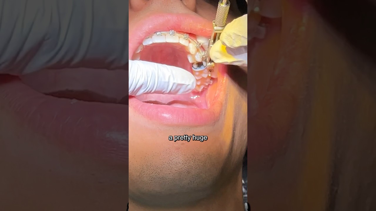 A pretty HUGE cavity with braces 🤯