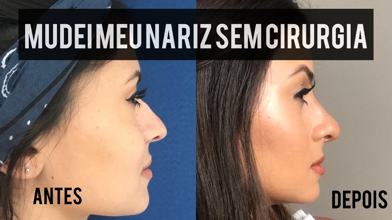 COMO MUDEI MEU NARIZ SEM CIRURGIA (Tudo sobre minha Rinomodelação) - Viihrocha