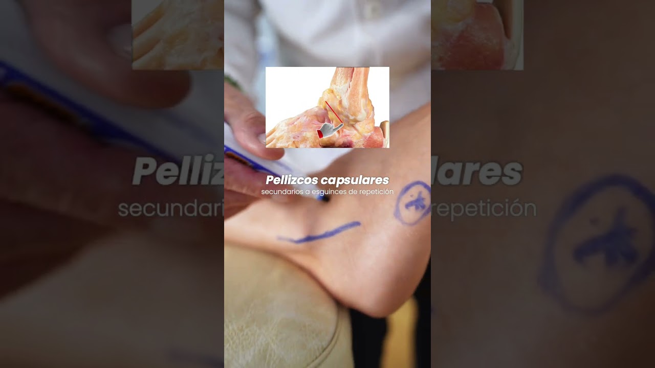 🦶 Dolor en el lateral del pie... &iquest;Sabes qu&eacute; lesi&oacute;n puede ser?
