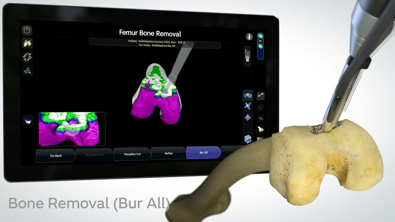 sportsmed first in AU to perform total knee replacement procedure with the CORI Surgical System