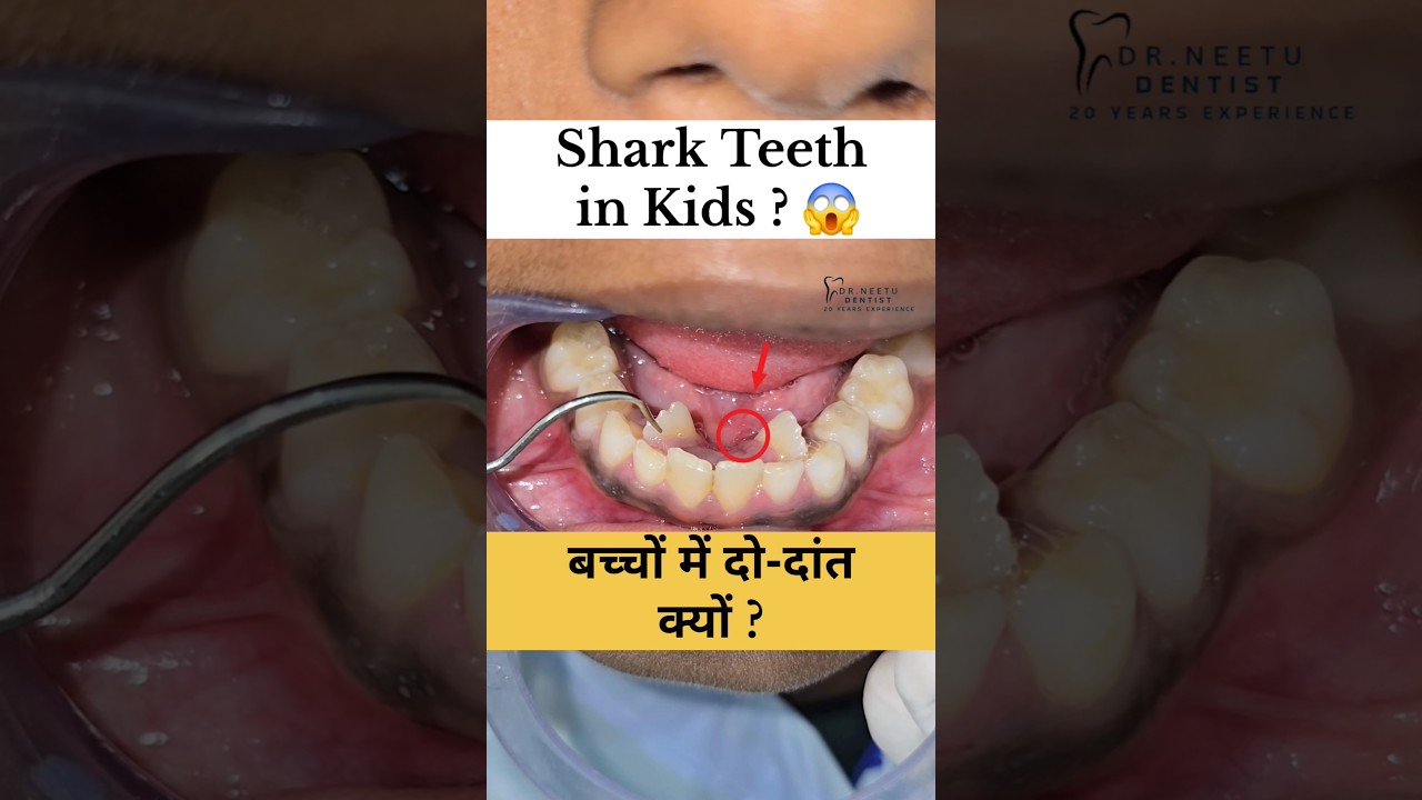 Shark Teeth in Kids, Double Row Teeth Treatment | बच्चों में शार्क‑टूथ, दो-दाँत का इलाज #shorts
