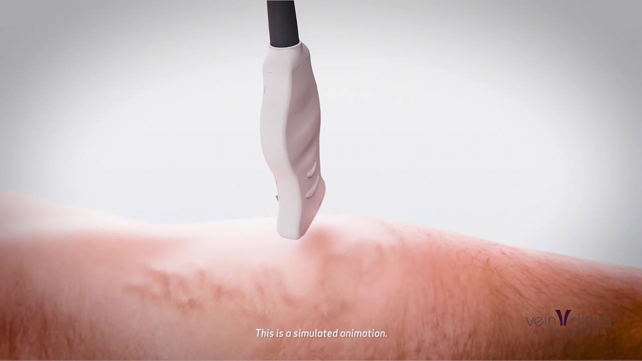 What is endovenous laser ablation treatment? | Vein Clinics of America