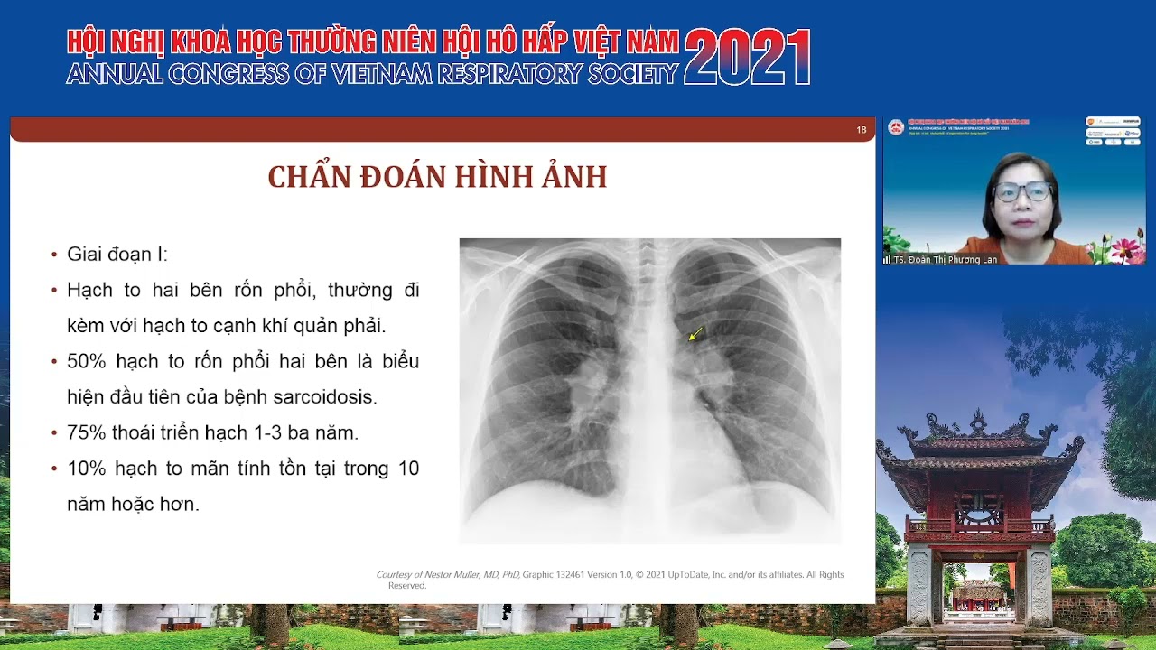 Chẩn đoán và điều trị sarcoidosis