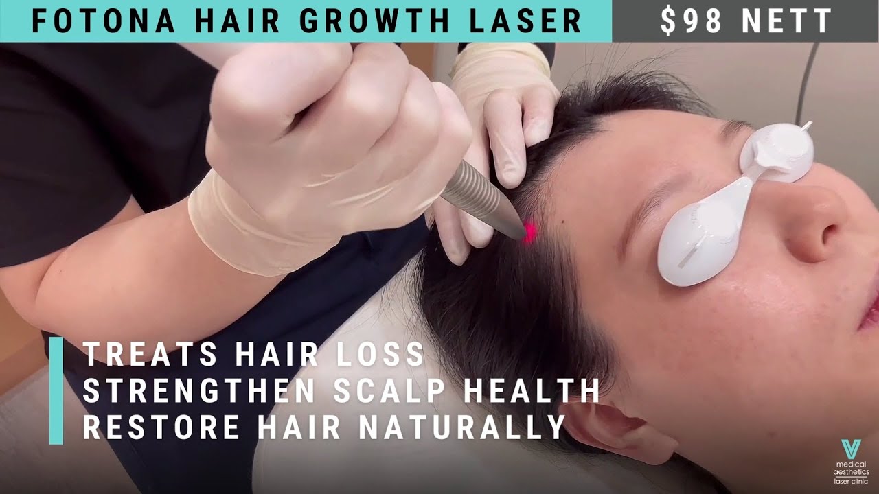 Fotona&reg; Hair Growth Laser Singapore | $98 - V Medical Aesthetics & Laser Clinic.