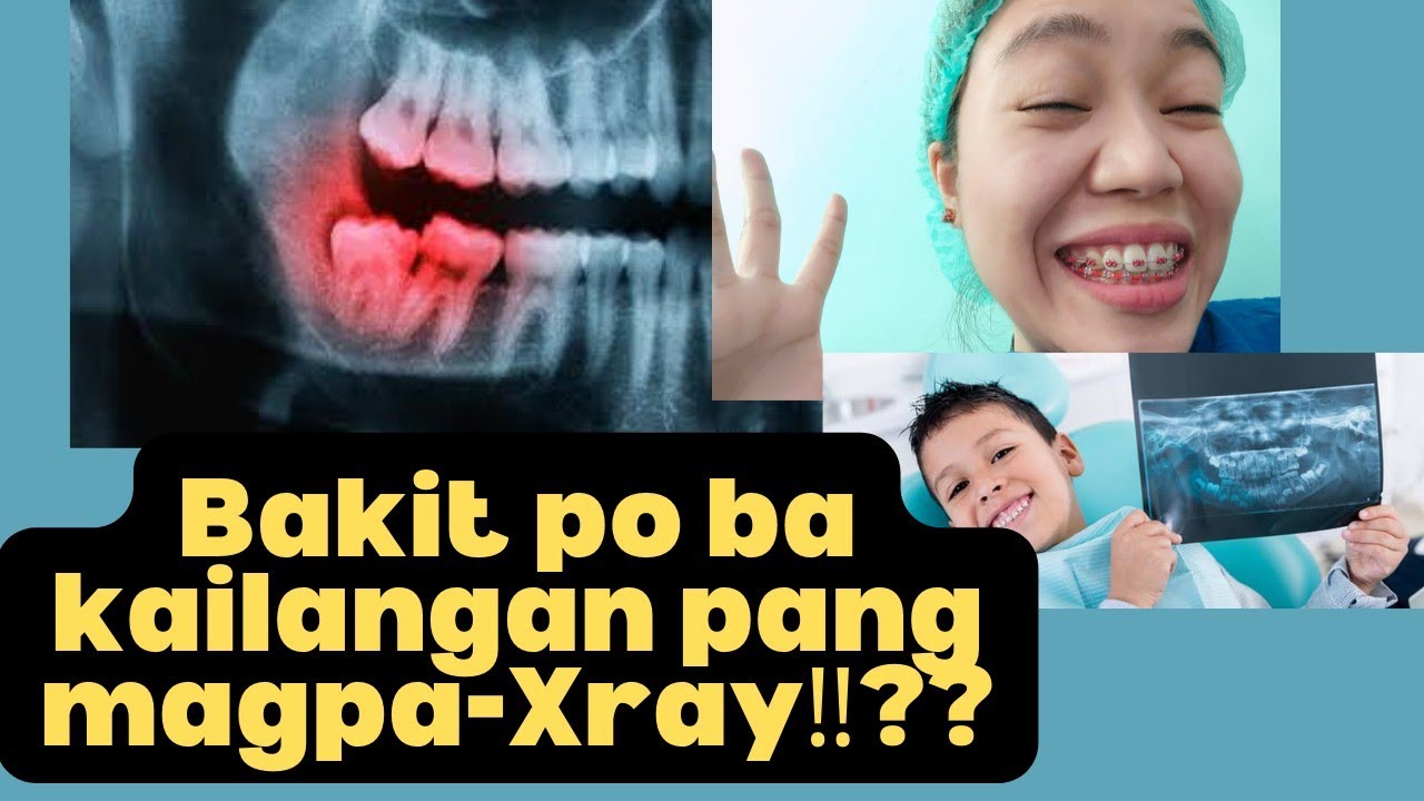 Kahalagahan Ng Dental Xray at Ang ibat ibang uri nito.