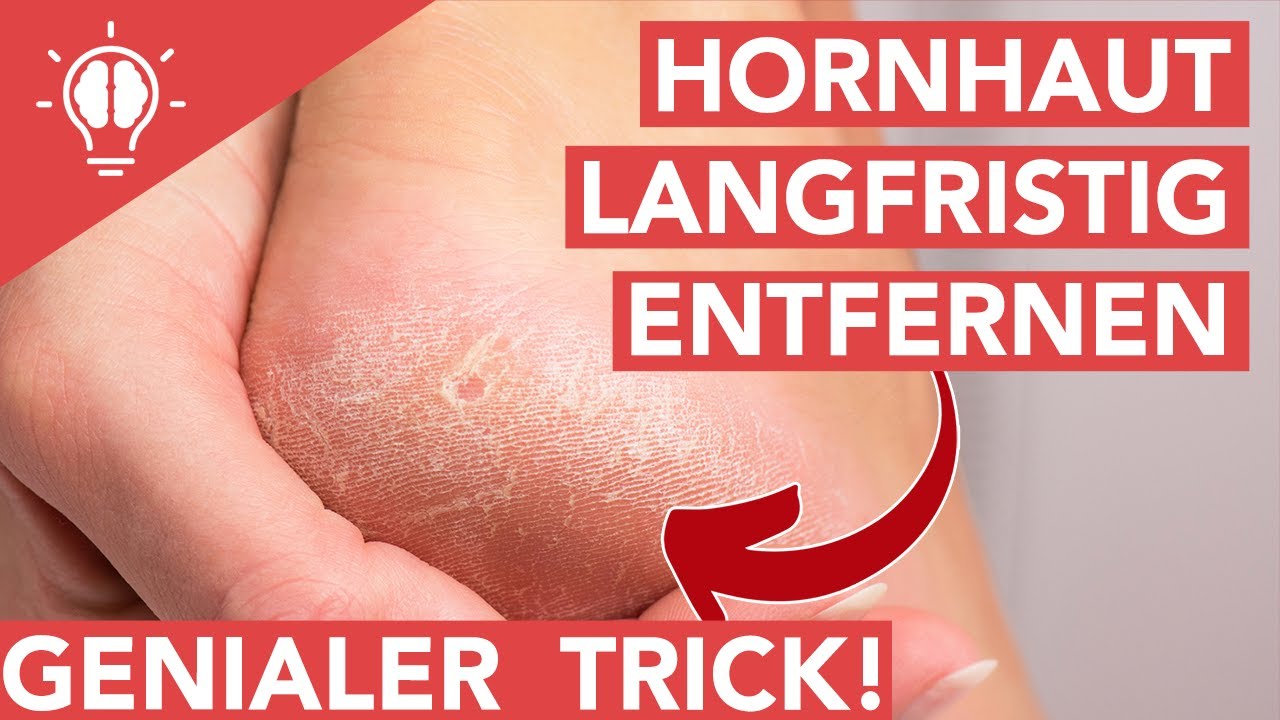 Hornhaut entfernen am Fuß - Beste und langfristige Lösung│ SanoGym