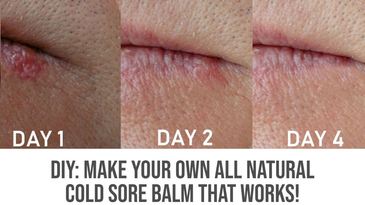 DIY: Make Your Own All Natural Cold Sore Balm That Works!