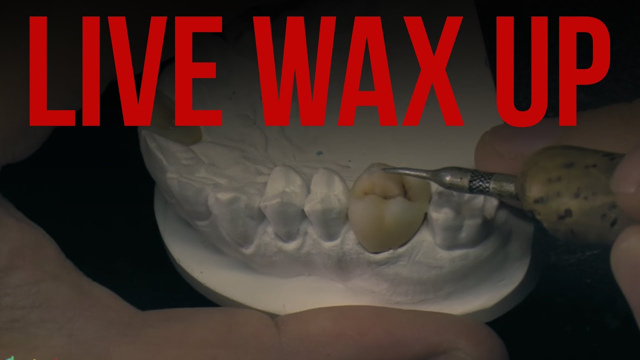 Live wax up. waxup modeling. Modeling tooth molar wax. Восковое моделирование
