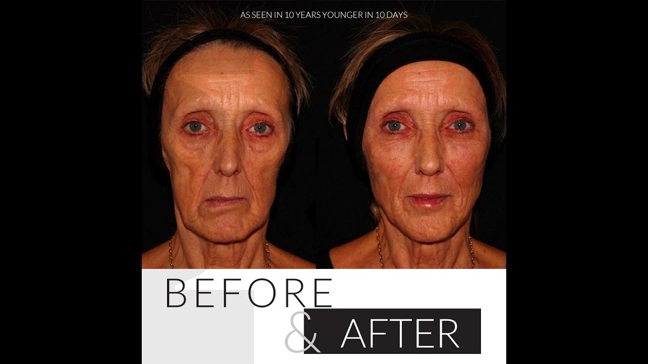 Jackie 10 Years Younger | PHI Clinic