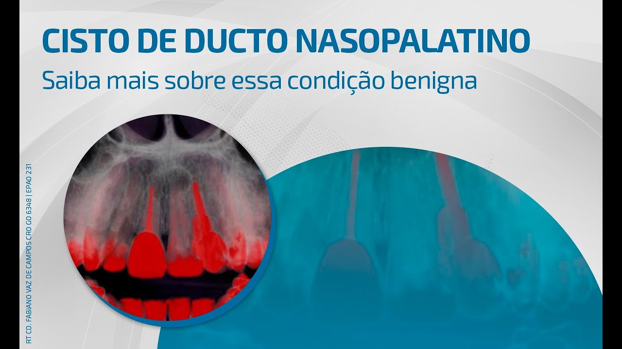 Cisto do Ducto Nasopalatino - Dra. Mayara Viandelli