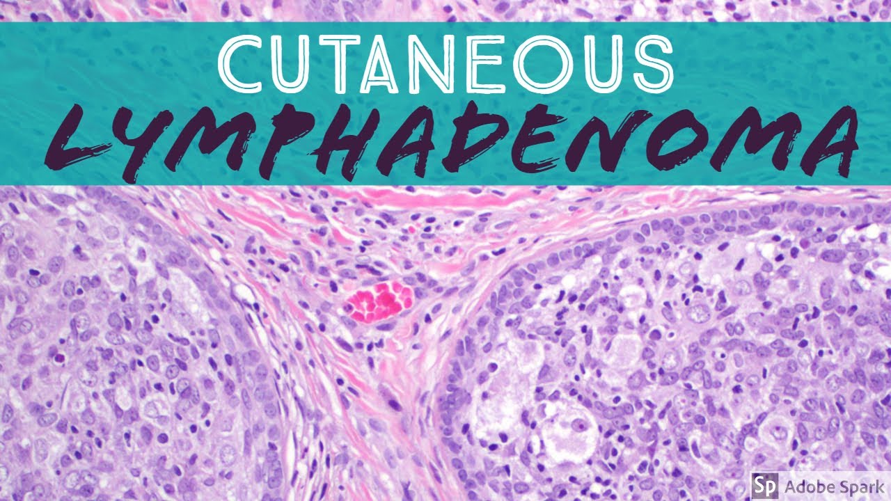 Cutaneous Lymphadenoma (Adamantinoid Trichoblastoma)