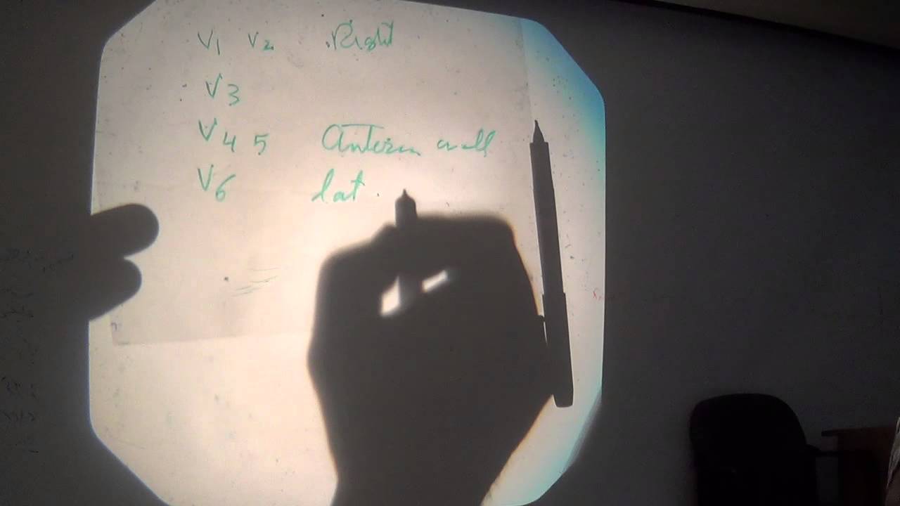 ECG 1