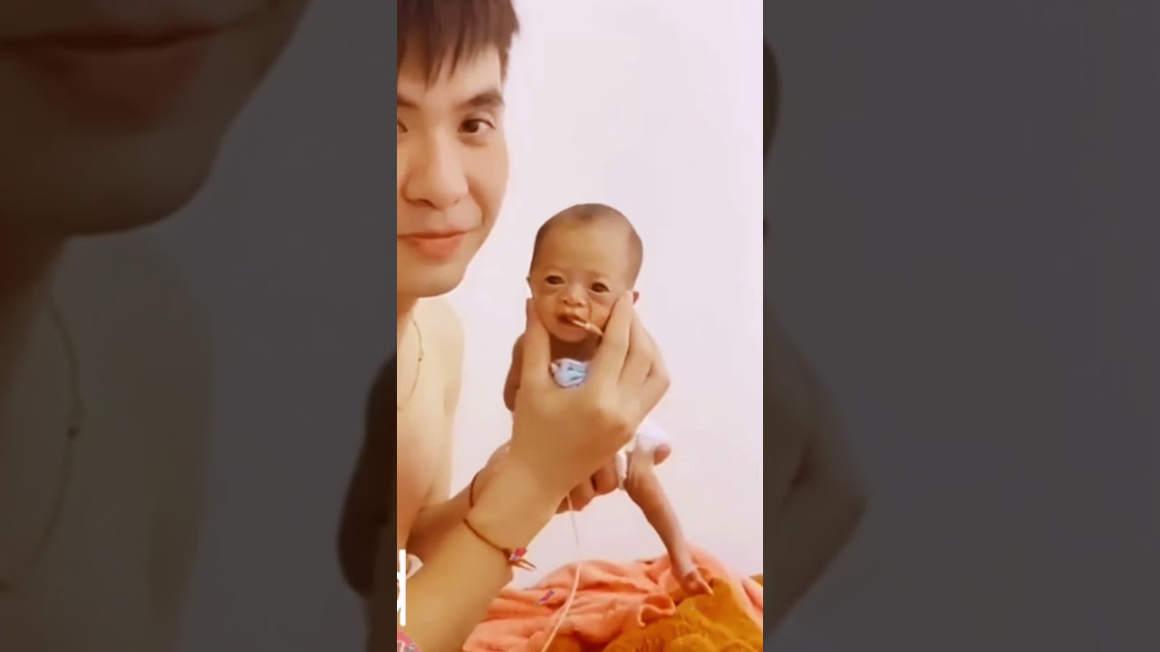 Premature Down Syndrome Baby Absolutely Beautiful 