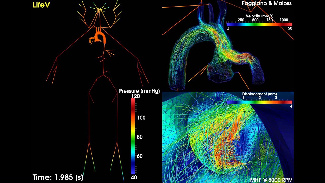 Numerical simulation of LVAD implant at 8000 RPM in a patient with moderate heart failure