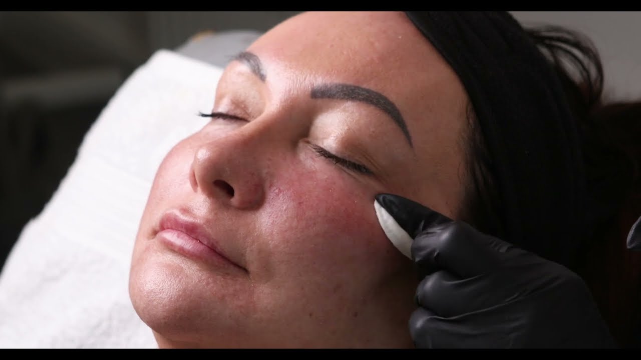 iLLUMA Luna Technique