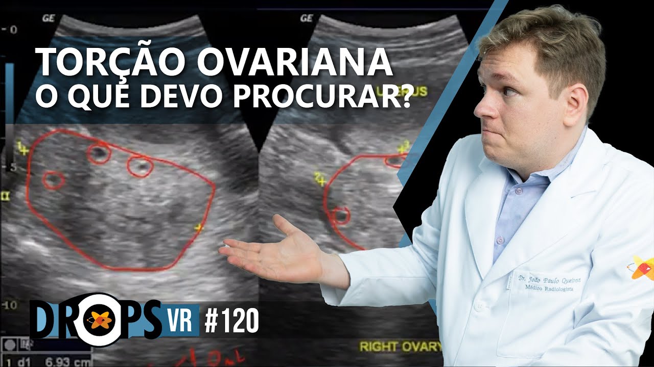 ACHADOS DE TORÇÃO OVARIANA NOS EXAMES DE IMAGEM