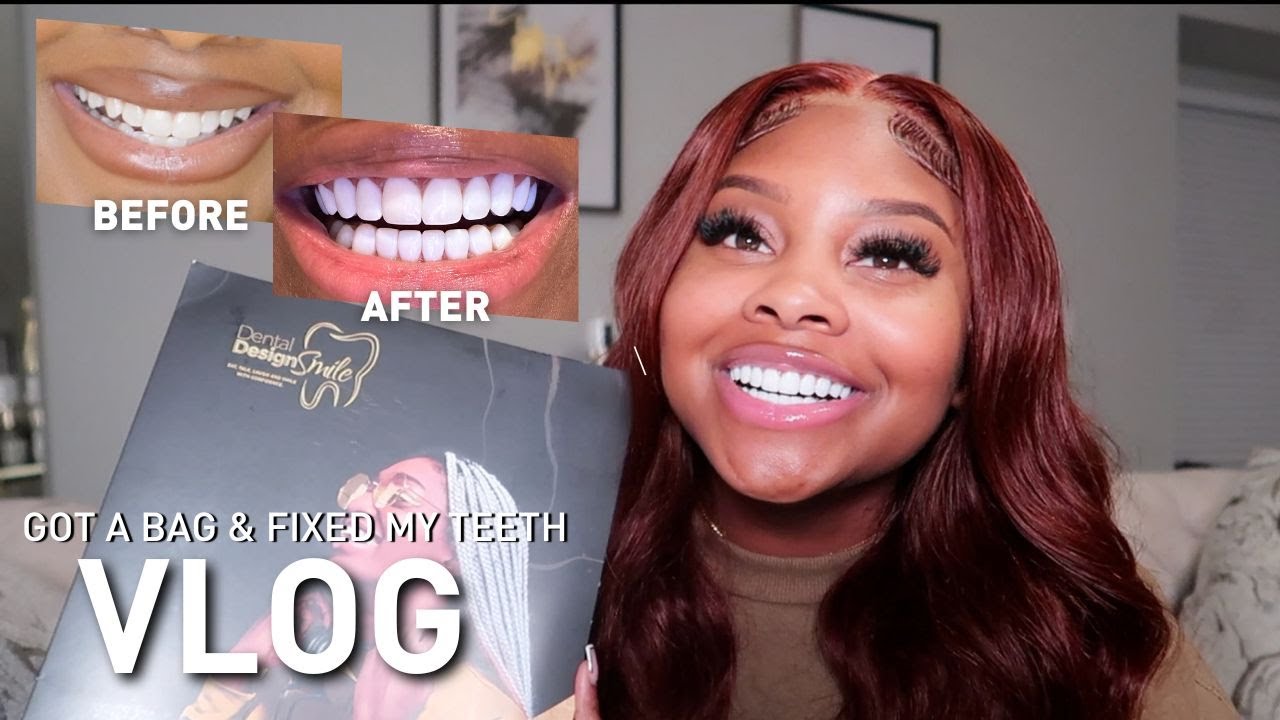 Revealing my NEW TEETH - I got Composite Resin Veneers by Dental Design Smile | Troyia Monay