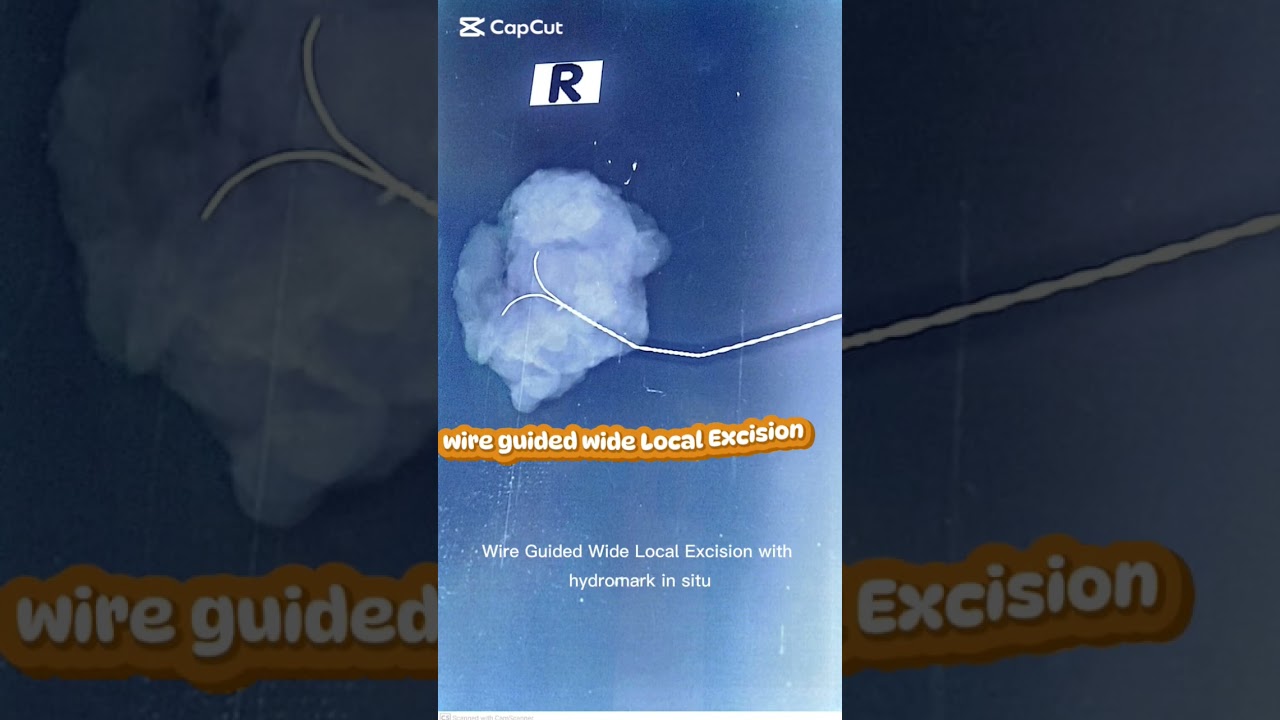 #breastcancer #wire_guide_wide local Excision