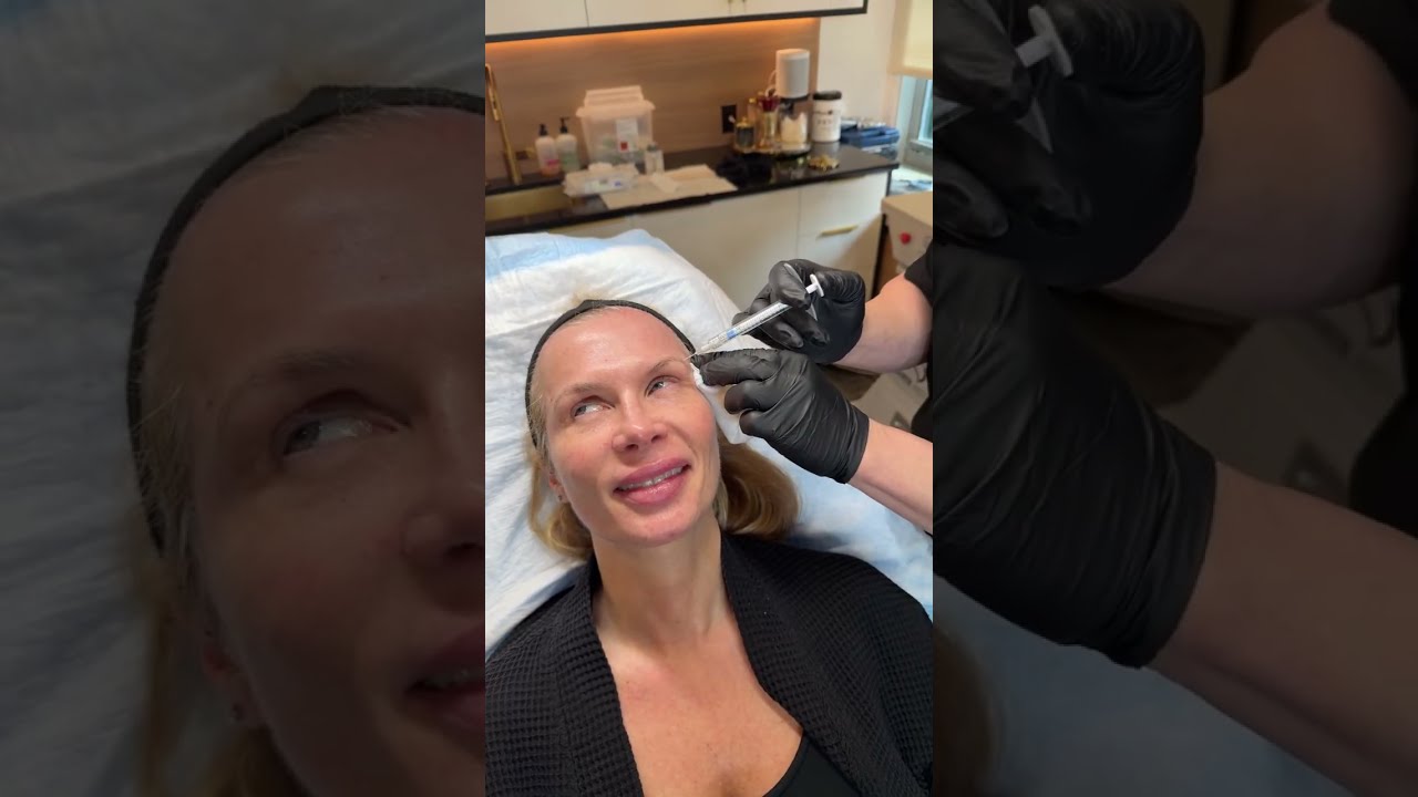 CELESTA NEW YORK CITY ASCENT WITH FILLERS AND THREADS NON-SURGICAL FACE LIFTING | Dr. Jason Emer