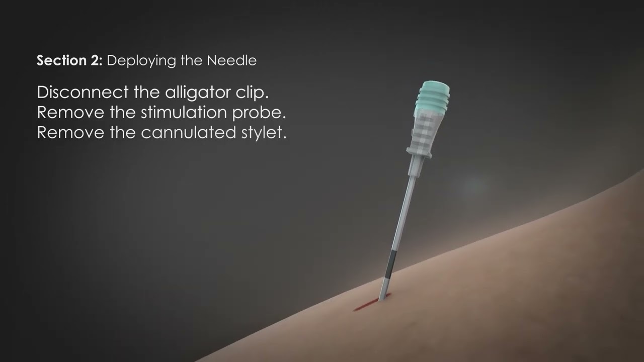 StimTrial Procedure Video