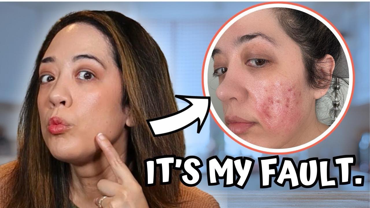 How I Destroyed My Skin: Mistakes You Should Avoid!