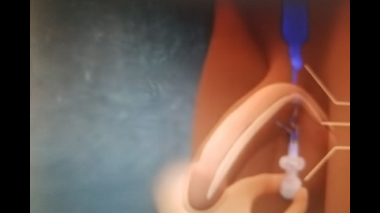 Comment traiter l'impuissance: la dysfonction &eacute;rectile, ses causes et ses traitements appropri&eacute;s.