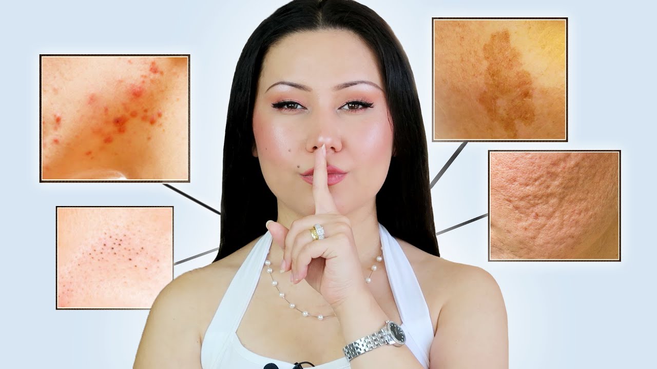 GET RID OF ACNE SCARS, DARK SPOTS & BLACKHEADS Super FAST & FOREVER | *This Is Life Changing*