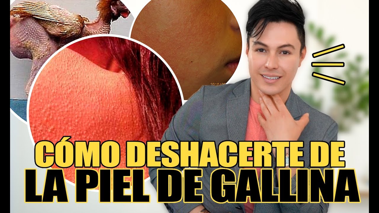 ¿Cómo Quitar La Piel de Gallina? (Queratosis Pilaris)