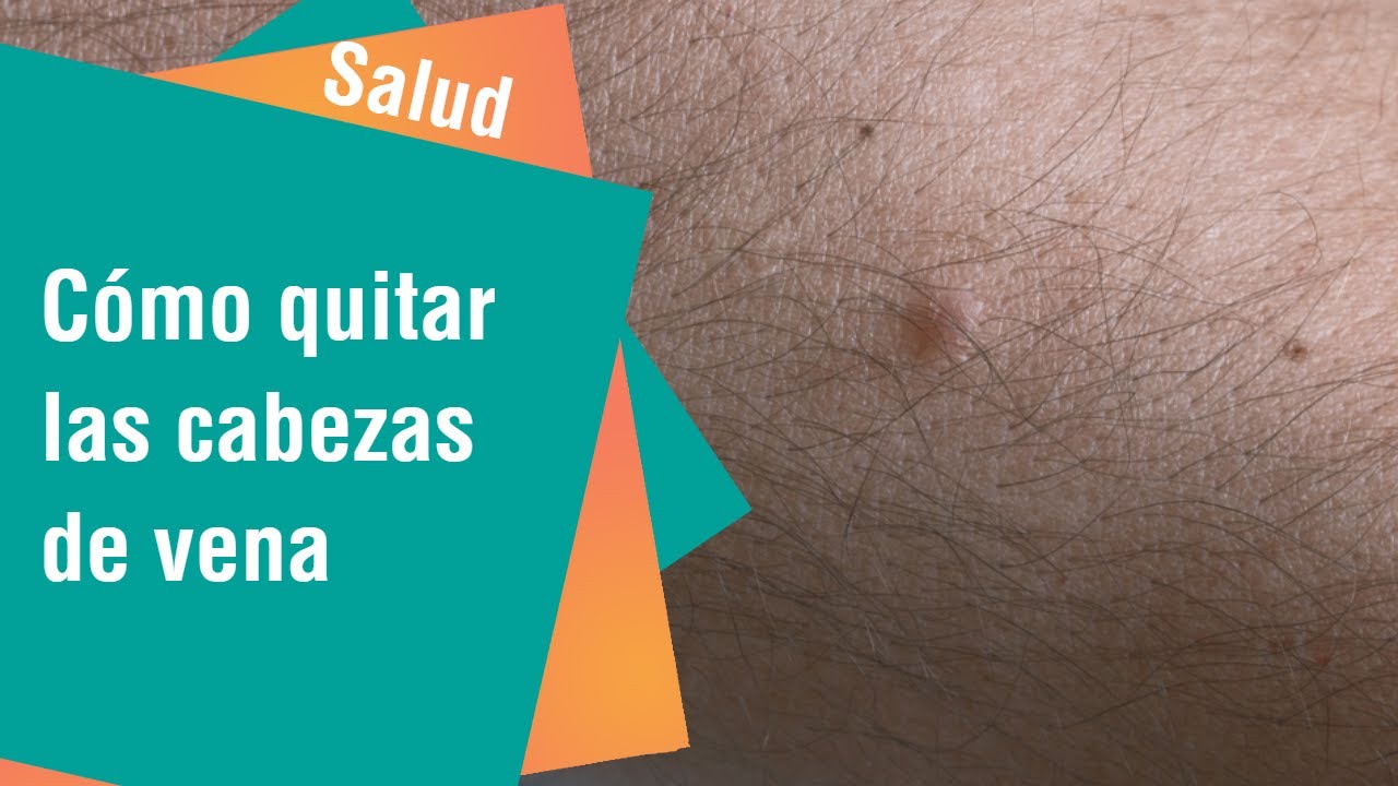 &iquest;C&oacute;mo quitar las cabezas de vena? | Salud