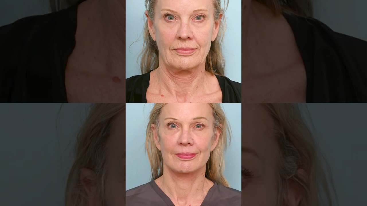 She Got a Deep Plane Facelift at 65 &ndash; See How Natural She Looks #Facelift