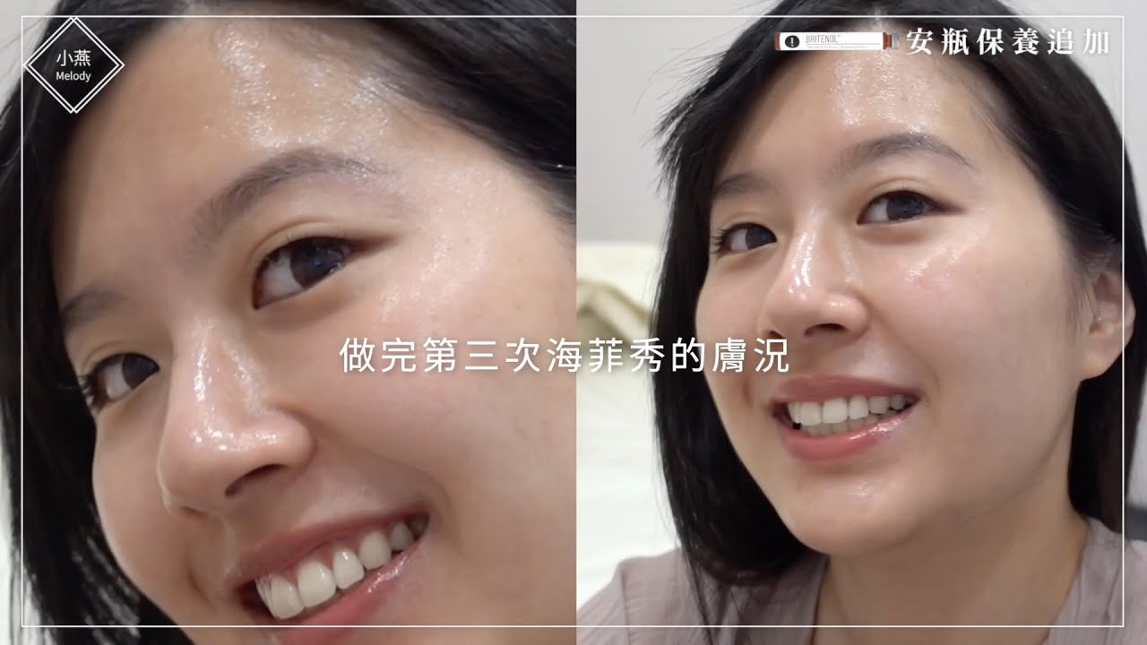 【粉刺界的Dyson】超狂毛孔大掃除－海菲秀 半年記錄 ft.佳飛雅JAVAYA｜小燕Melody