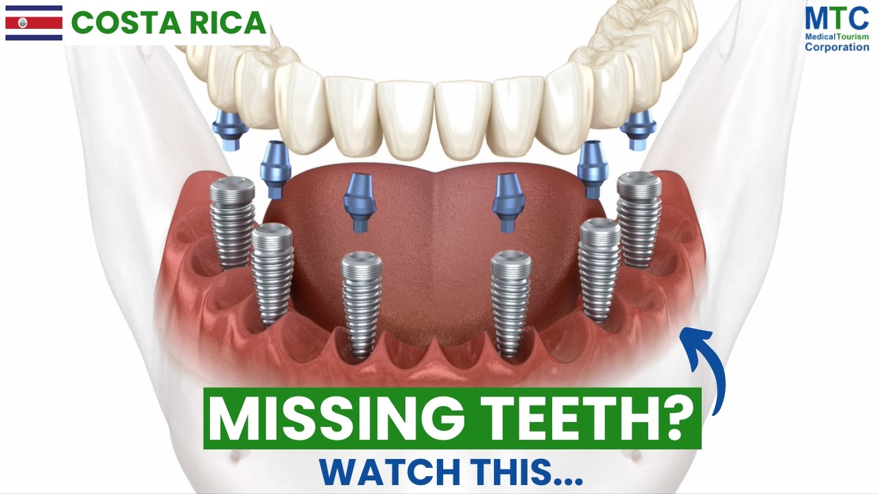 All on 6 Dental Implants in Costa Rica: Your Full Mouth Restoration Trip Guide!