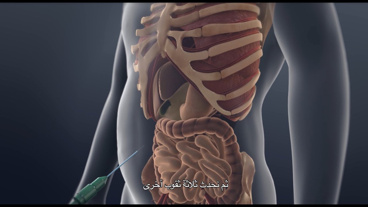 Gallbladder Removal