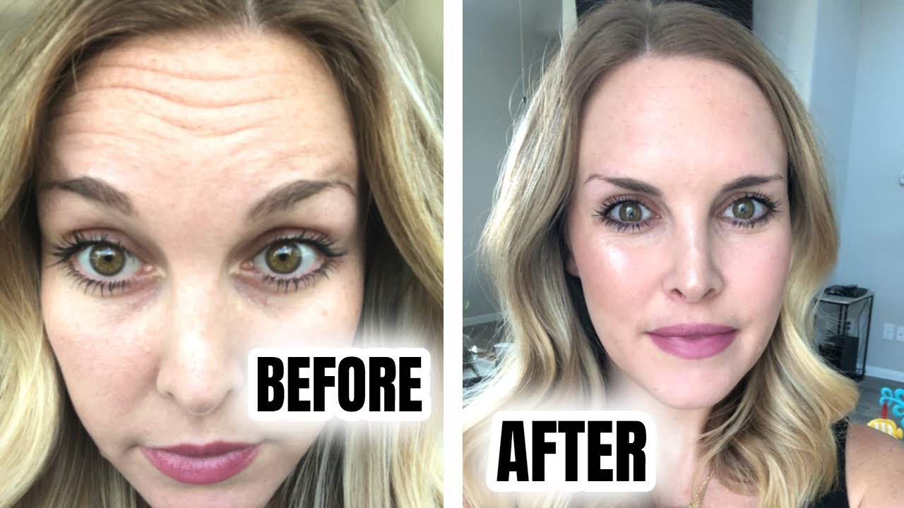 BOTOX: BEFORE & AFTER + 8 DAY PROGRESSION (post pregnancy)