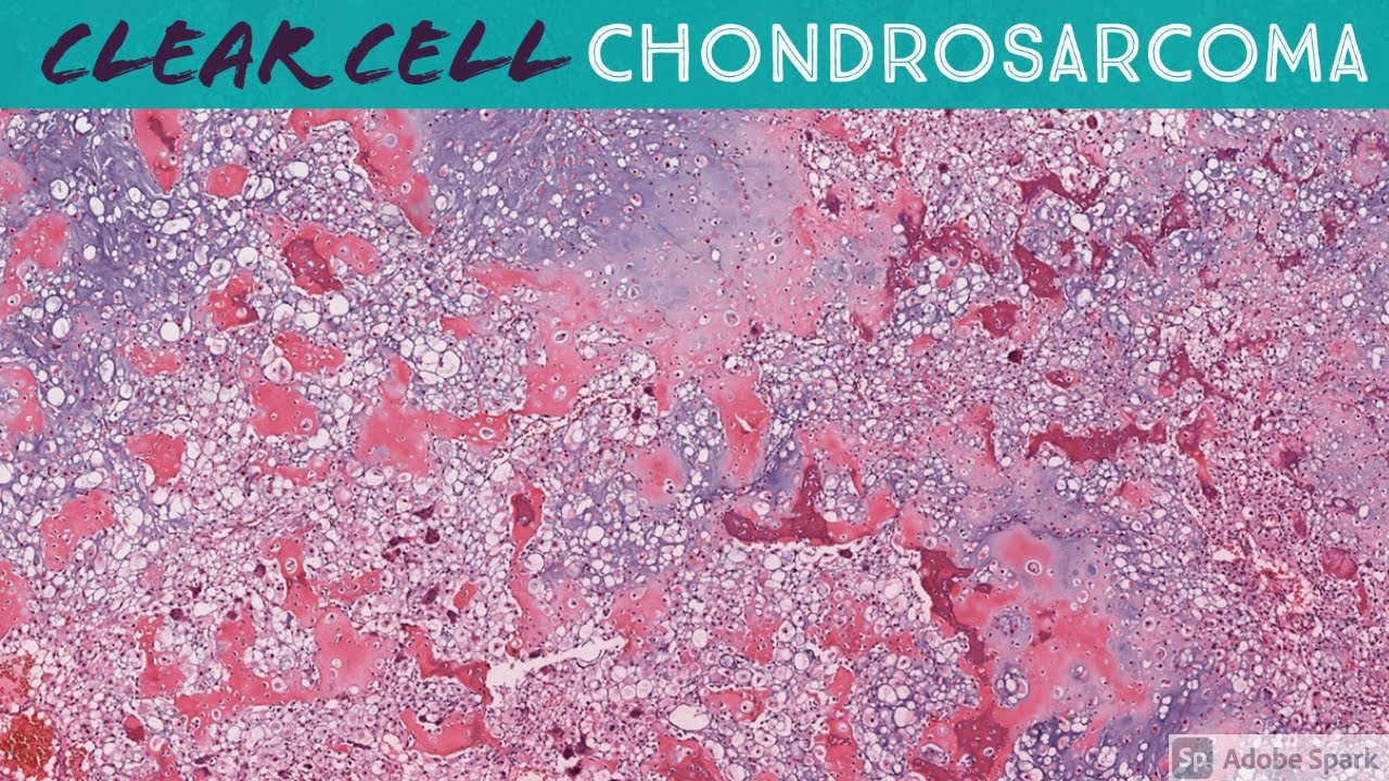 Clear Cell Chondrosarcoma