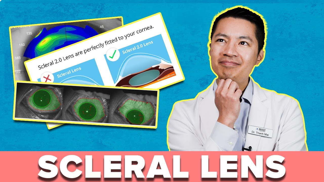 What To Expect During Your Scleral Lens Fitting