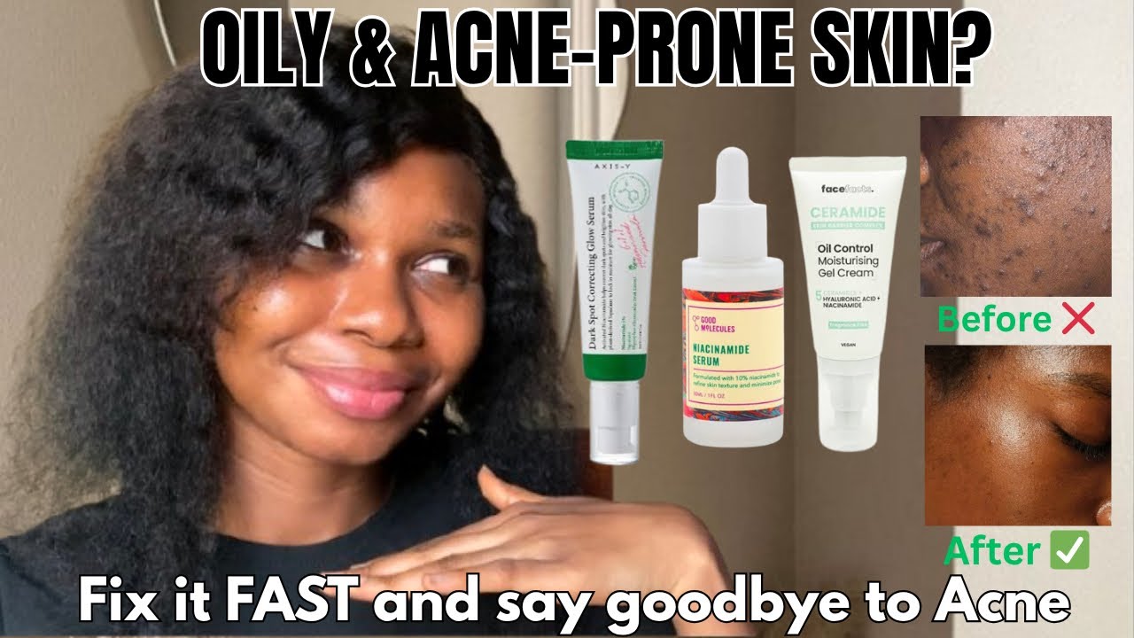 Best Skincare Routine for Oily & Acne-Prone Skin  | Clear Skin & Products for Smooth, Glowing Skin