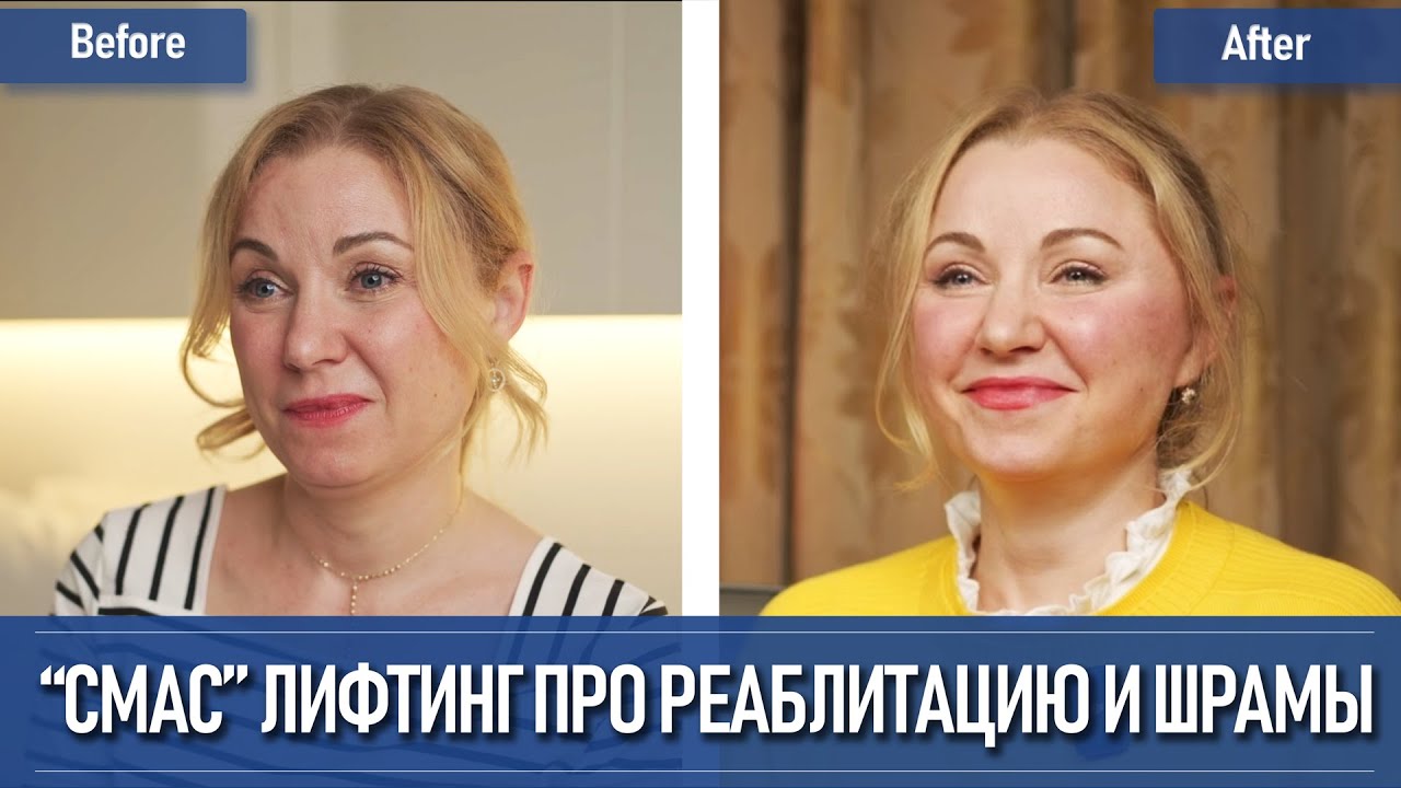 Лифтинг лица о шрамах и реабилитации, отзыв о лифтинге в Южной Корее