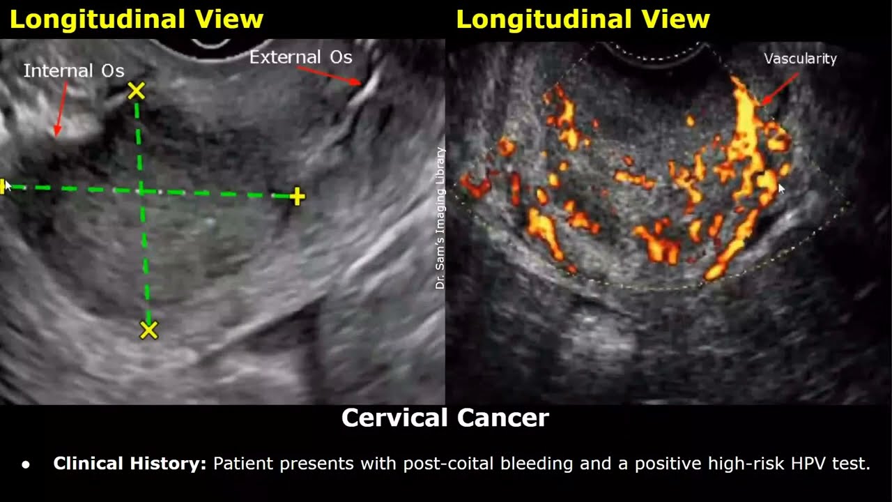 Cervix Ultrasound Reporting | Nabothian Cysts, Polyp, Fibroid, Cervical Incompetence, Cancer USG