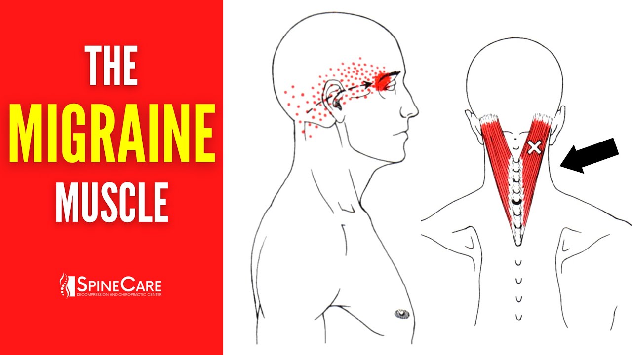How to Release Tension for FAST MIGRAINE RELIEF