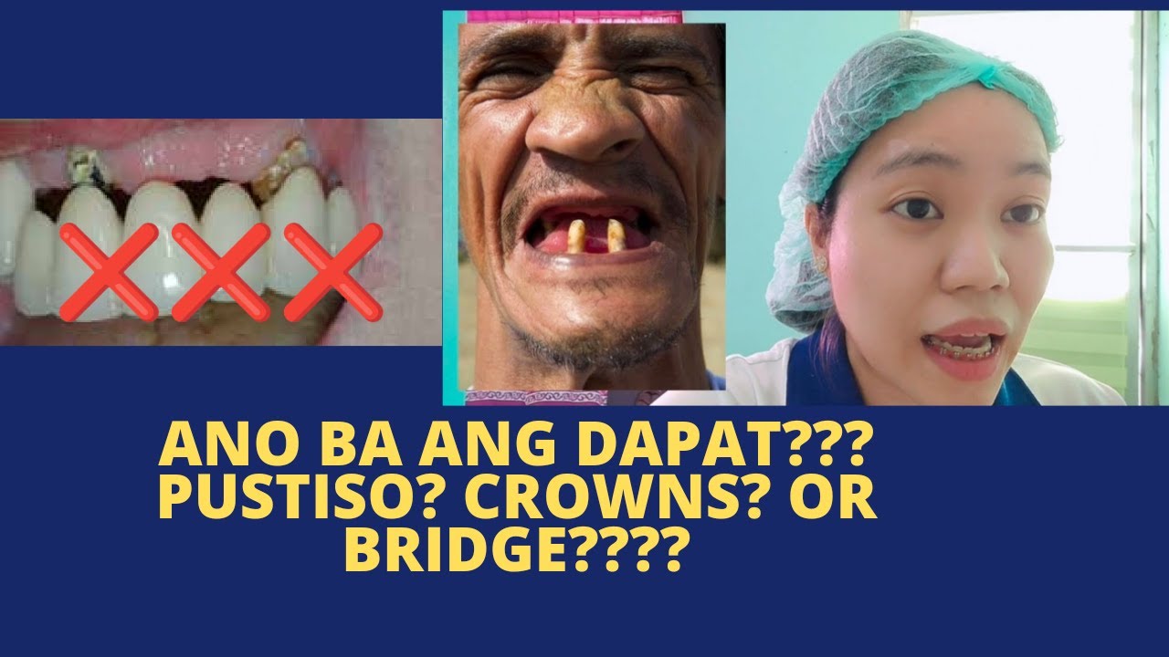 Pustiso, Jacket Crown at Dental Bridge : Alamin Ang Pagkakaiba-iba