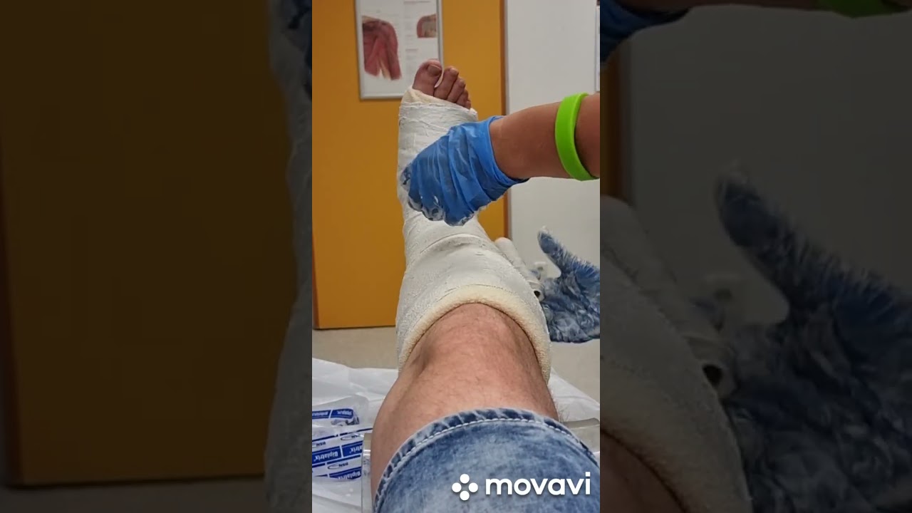 Gipsverband anlegen Fuß