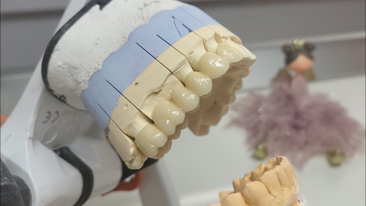 ASMR Ceramic Bridge / 6-units / IPS InLine on Cr-Co / Basic Layering